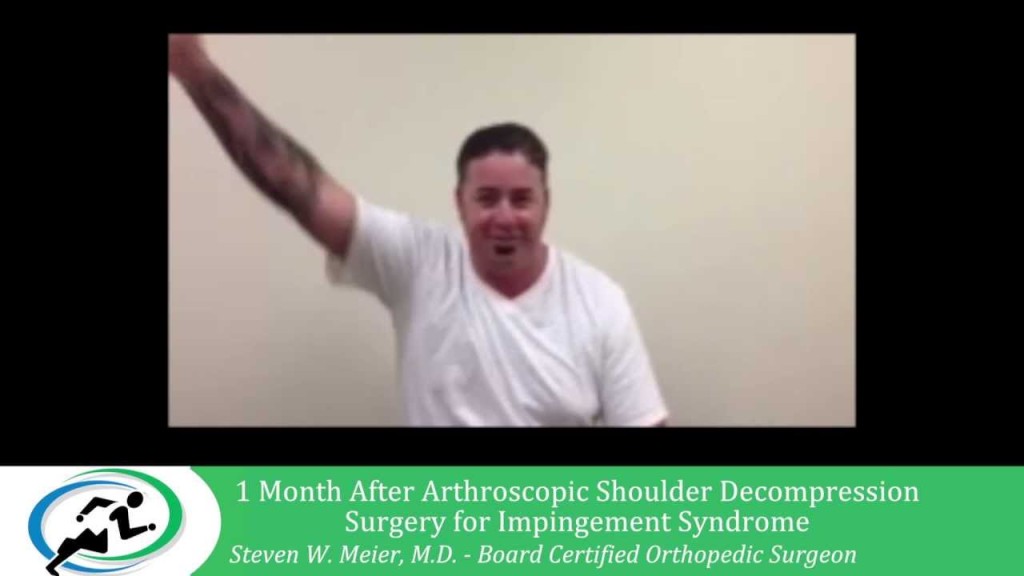 Arthoscopic Impingement Syndrome Treatment Los Angeles