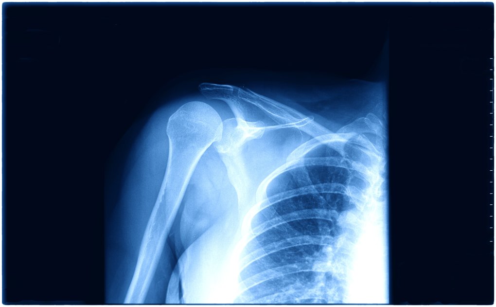 X-ray of a shoulder undergoing checkup before proceeding with a shoulder instability surgery